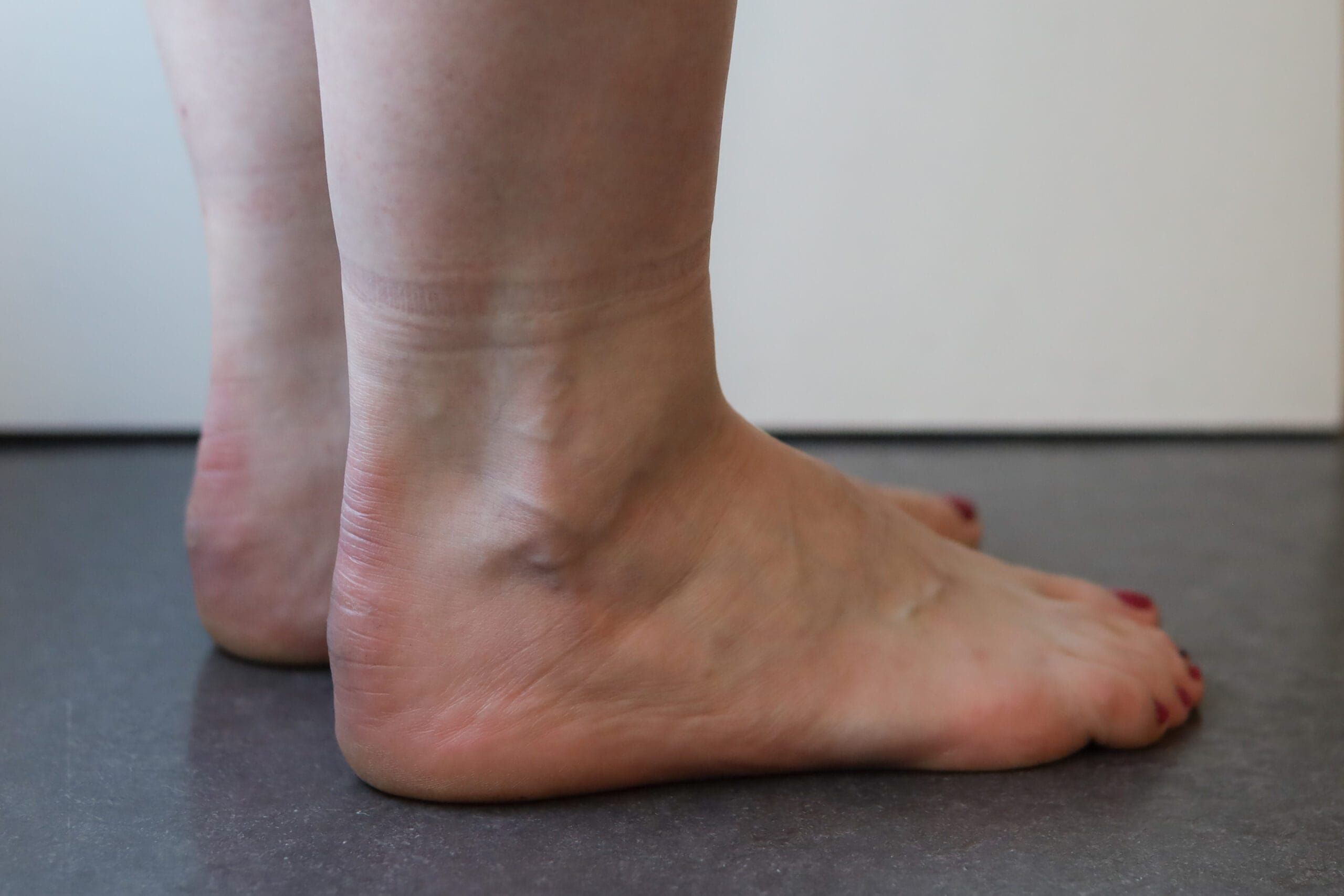 revalidatie na achillespees ruptuur bij fysiotherapie Nijmegen van Sport Medisch Centrum Papendal