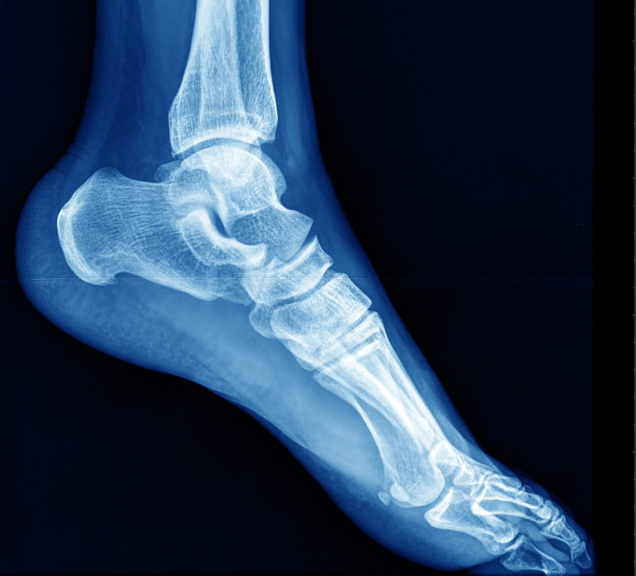 behandeling van stressfractuur in fysiotherapie nijmegen